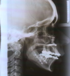 cirugia maxilofacial